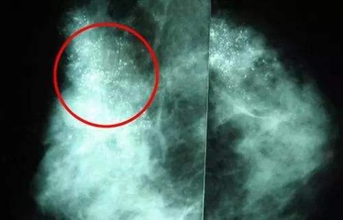 乳腺癌篩查神器一一鉬靶檢查